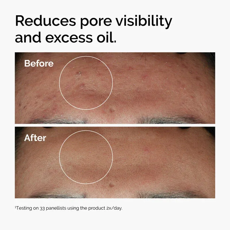 ord-niacinamide-zinc-blemish-serum-before-after-pores (1).webp